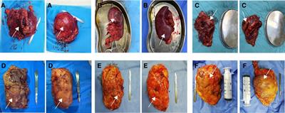 Retroperitoneal laparoscopic radical nephrectomy (RLRN) is associated with poor integrity of Gerota's fascia and perirenal fat: A prospective comparative study